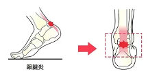 足部問題莫忽視跟腱炎，愛矯健科學干預促進健康