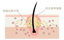 青春期臉上長白色的小痘痘怎么辦？米迪豆專業(yè)祛痘值得信賴！